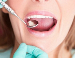 Зубные пломбы заменят лекарством от слабоумия